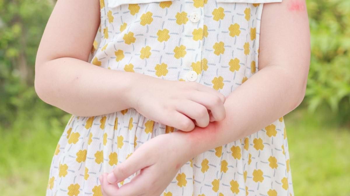 Provocările vacanțelor de vară pentru copiii cu psoriazis